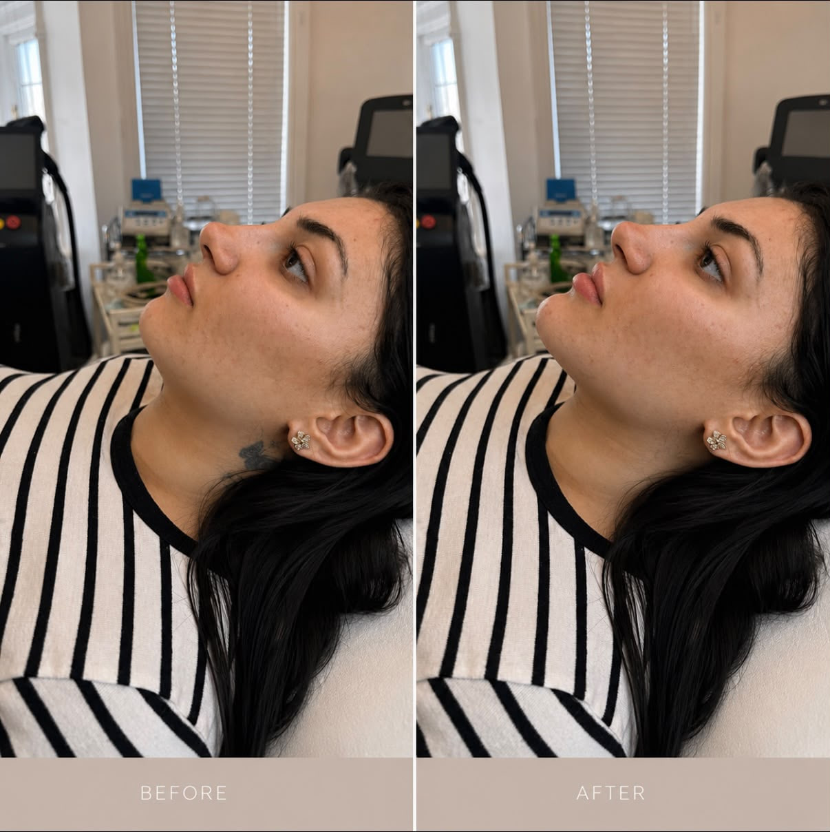 Before and after chin enhancement treatment